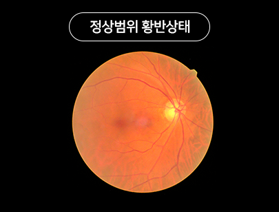 정상범위 황반상태