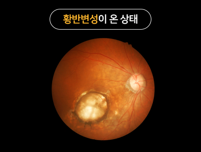 황반변성이 온 상태