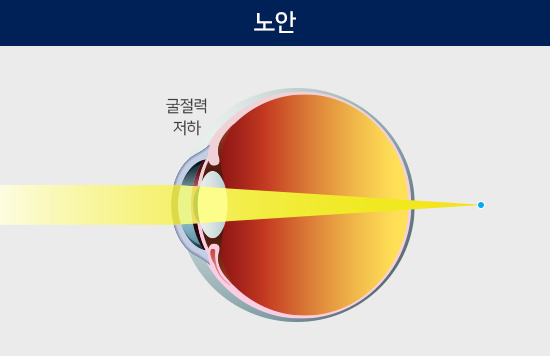 백내장 안구