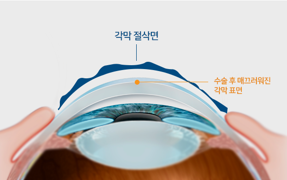 EX 500 엑시머레이저는 환자의 울퉁불퉁하고 불규칙한 각막 표면을 높낮이별로 구분해 다듬어 개선된 수술결과를 제공합니다.
