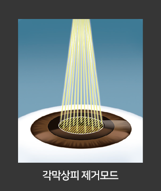 각막상피 제거모드
