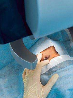 Catract Surgery