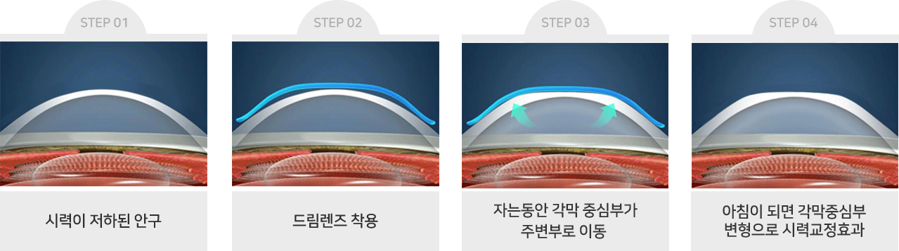 시력이 저하된 안구 , 드림렌즈 착용 , 자는동안 각막 중심부가 주변부로 이동,아침이 되면 각막중심부 변형으로 시력교정효과